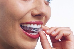 Prozirni aparatić za zube – Invisalign
