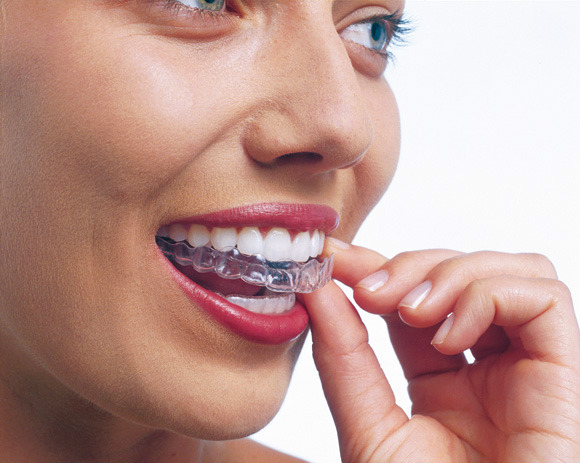 Prozirni aparatić za zube – Invisalign