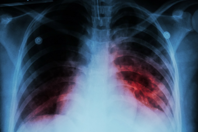 Tuberkuloza u 2021. najsmrtonosnija zarazna bolest u svijetu nakon COVID-a