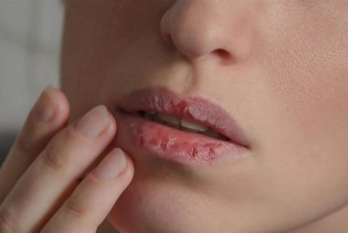 Pet prirodnih načina za njegu ispucalih usana