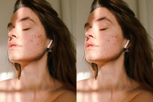 Zašto akne izbijaju na određenim dijelovima lica i tijela?
