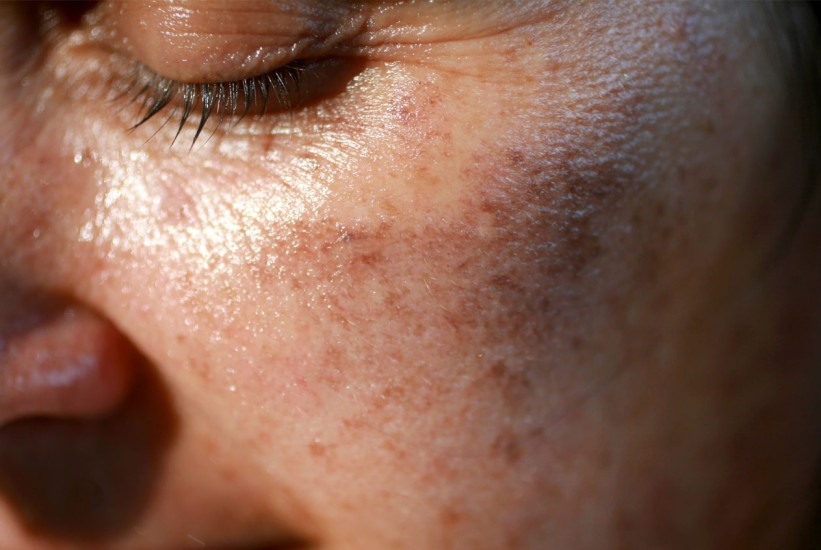 Staračke pjege nestaju u 4 sedmice: Dermatolozi otkrivaju kako!