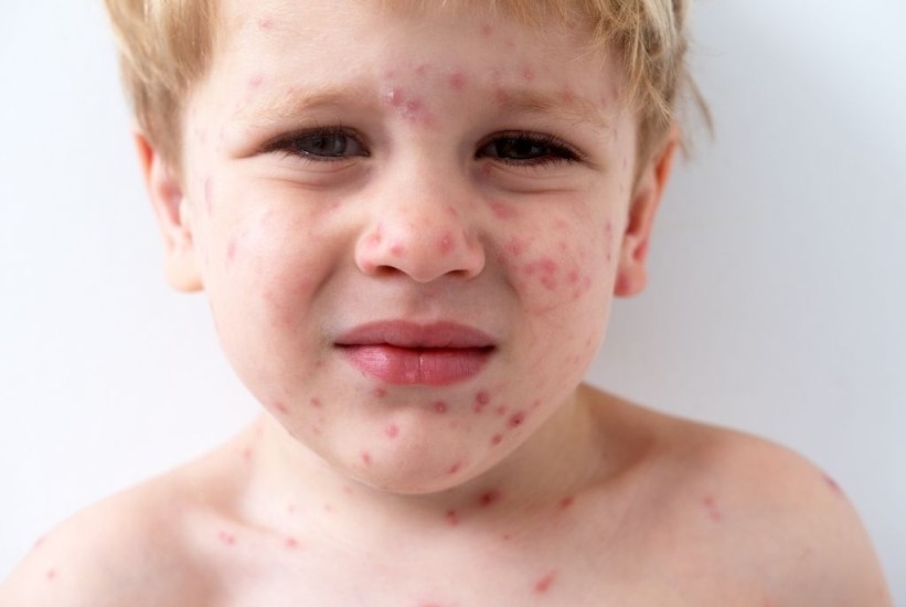 Vodene kozice: Šta roditelji trebaju znati o najčešćoj dječjoj bolesti