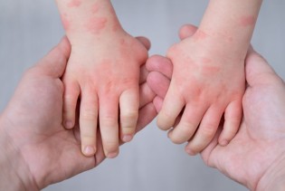 Širenje bolesti u sarajevskim vrtićima: Šta roditelji trebaju znati?