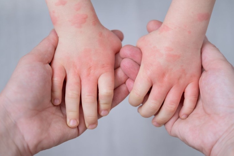 Širenje bolesti u sarajevskim vrtićima: Šta roditelji trebaju znati?