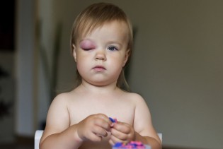 Periorbitalni celulitis kod djece: Šta svaka mama treba znati