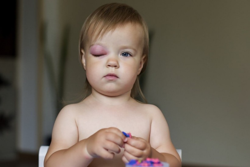 Periorbitalni celulitis kod djece: Šta svaka mama treba znati