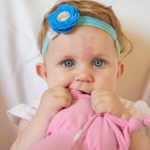 Primijetili ste crvenu mrlju na potiljku bebe? Evo šta je rodin ugriz i treba li brinuti