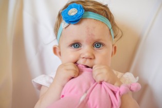 Primijetili ste crvenu mrlju na potiljku bebe? Evo šta je rodin ugriz i treba li brinuti
