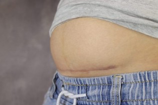 Šta jesti nakon carskog reza? Ove namirnice mogu pomoći tijelu tokom oporavka